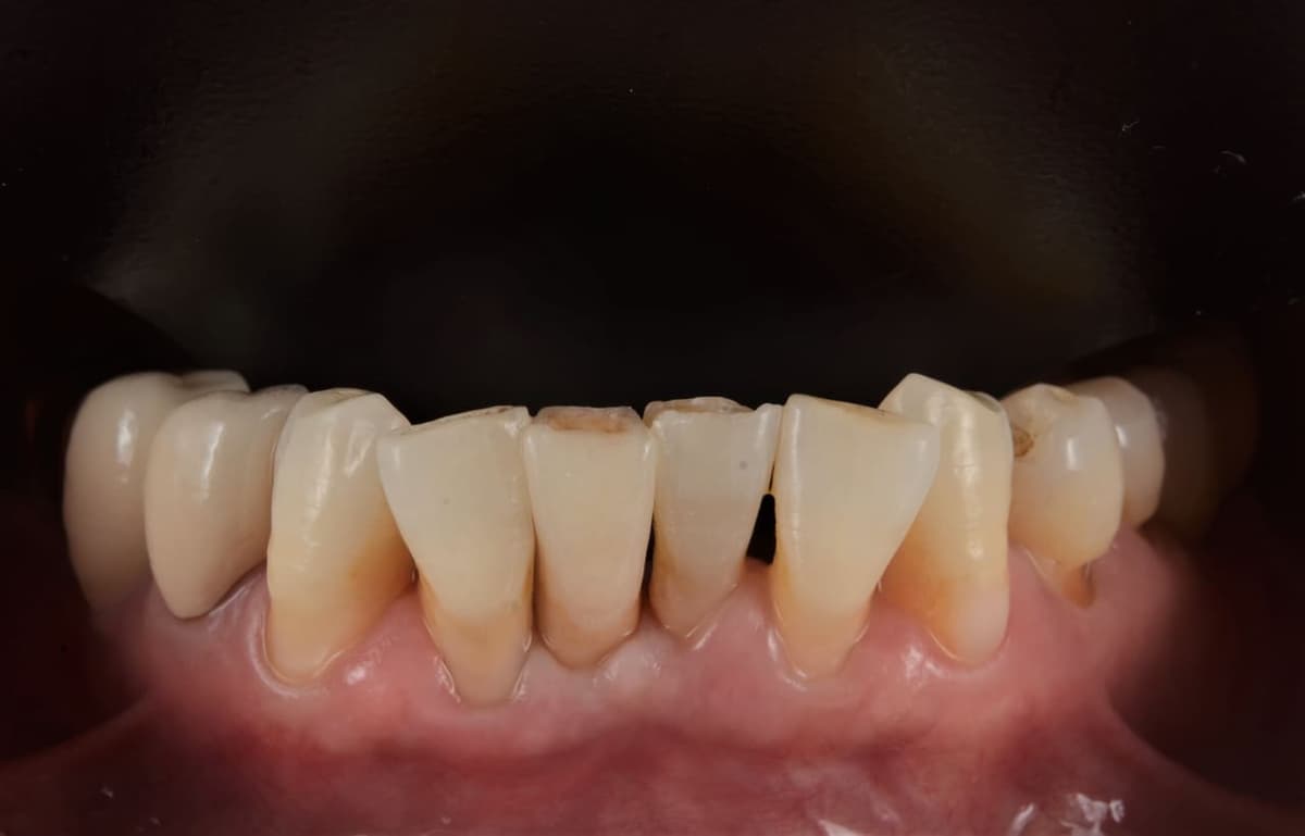 Implant răng cửa dưới — sau điều trị