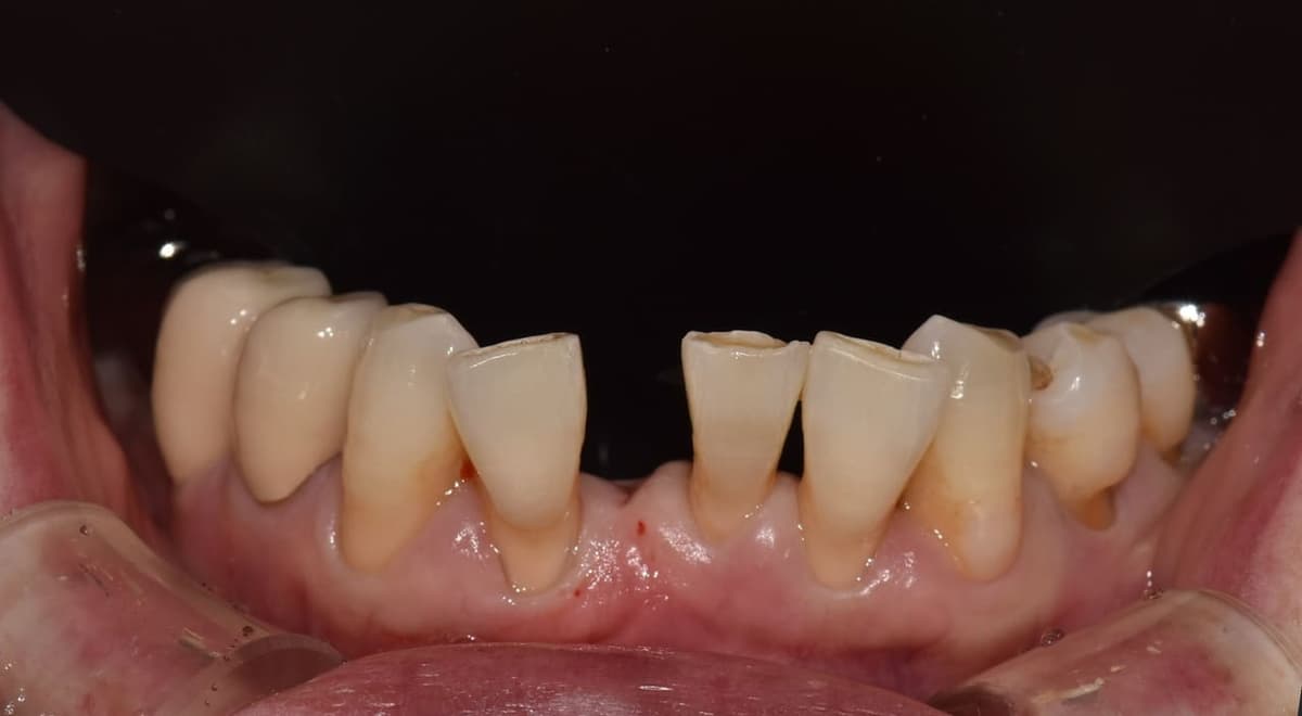 Implant răng cửa dưới — trước điều trị