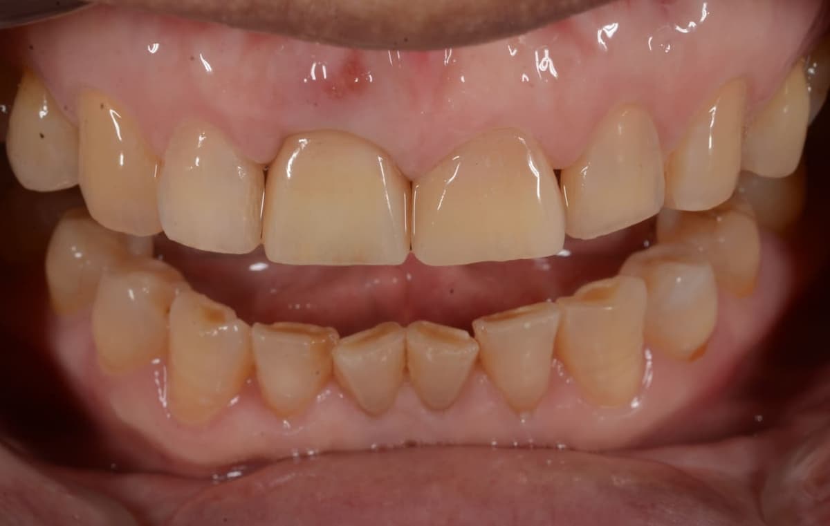 Implant răng cửa trên — sau điều trị