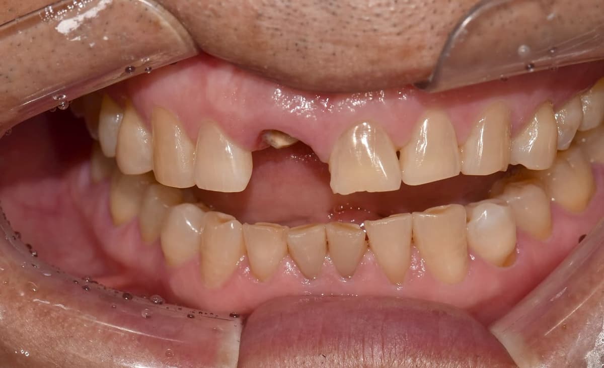 Implant răng cửa trên — trước điều trị