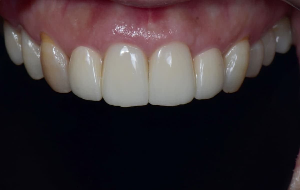 Implant và mão sứ răng cửa trên — sau điều trị