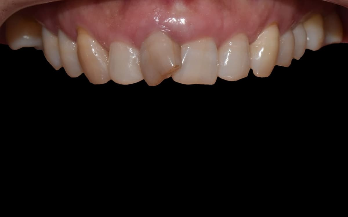 Implant và mão sứ răng cửa trên — trước điều trị
