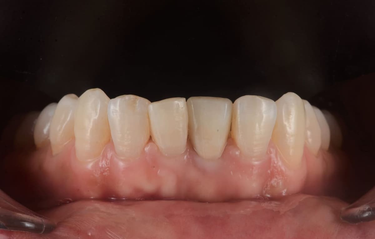 Phục hình trên Implant răng cửa dưới — sau điều trị