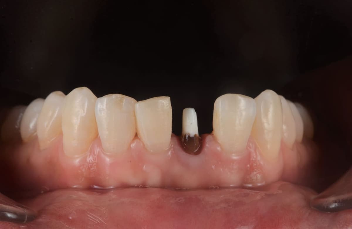 Phục hình trên Implant răng cửa dưới — trước điều trị