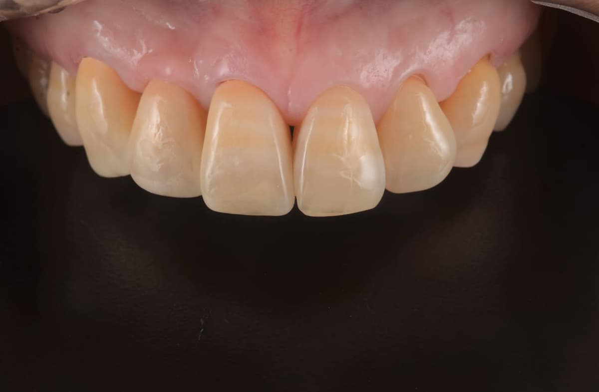 Phục hình răng cửa hàm trên được làm lại theo màu và vân bề mặt của răng bên cạnh